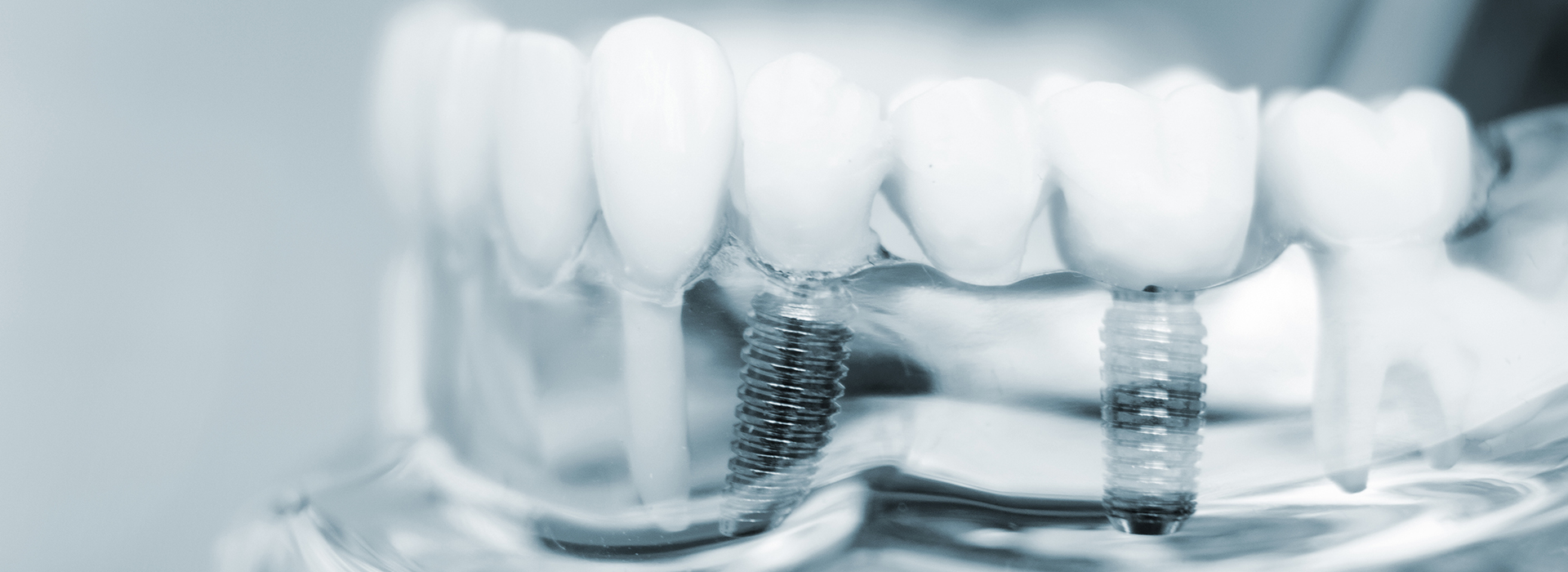 Implants Dentist near Lockhart TX
